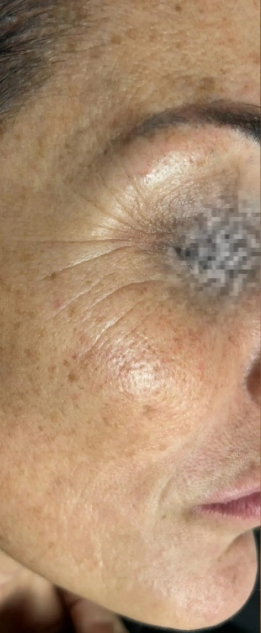 Prima trattamento botox caso 2