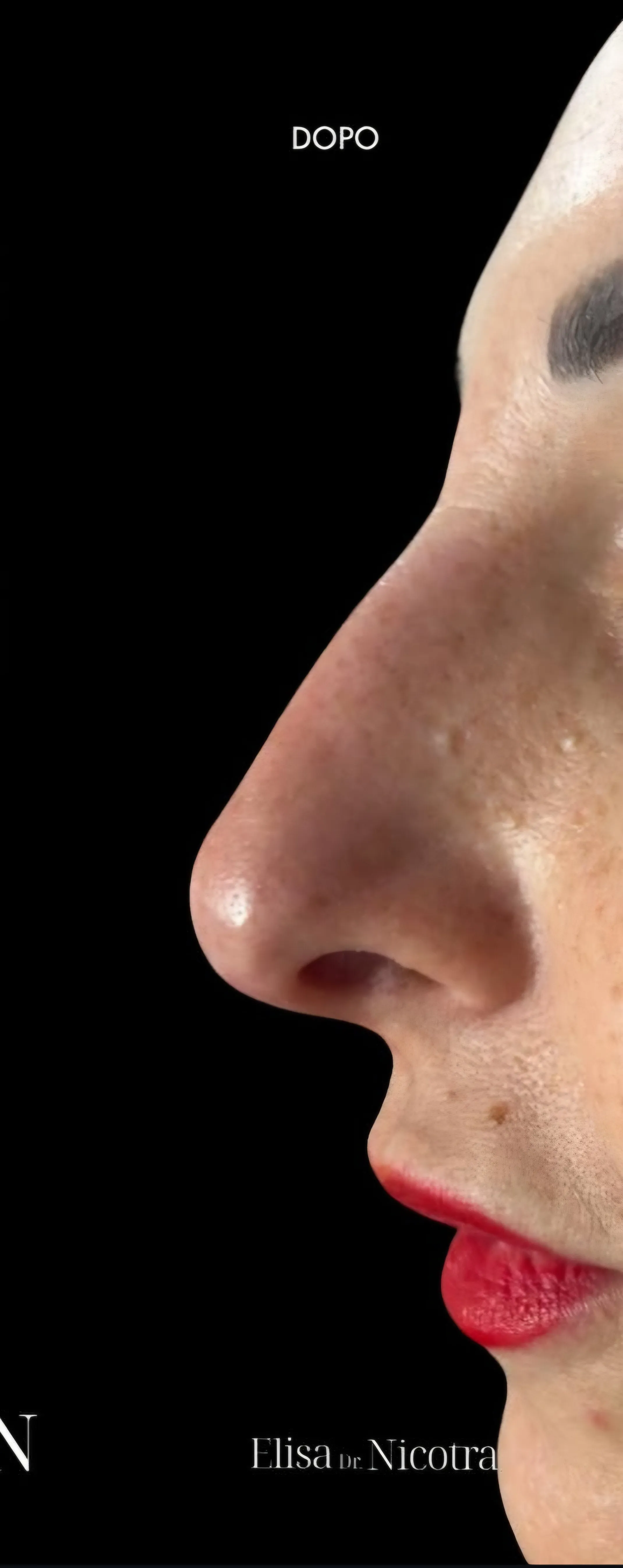 Dopo trattamento filler caso 1