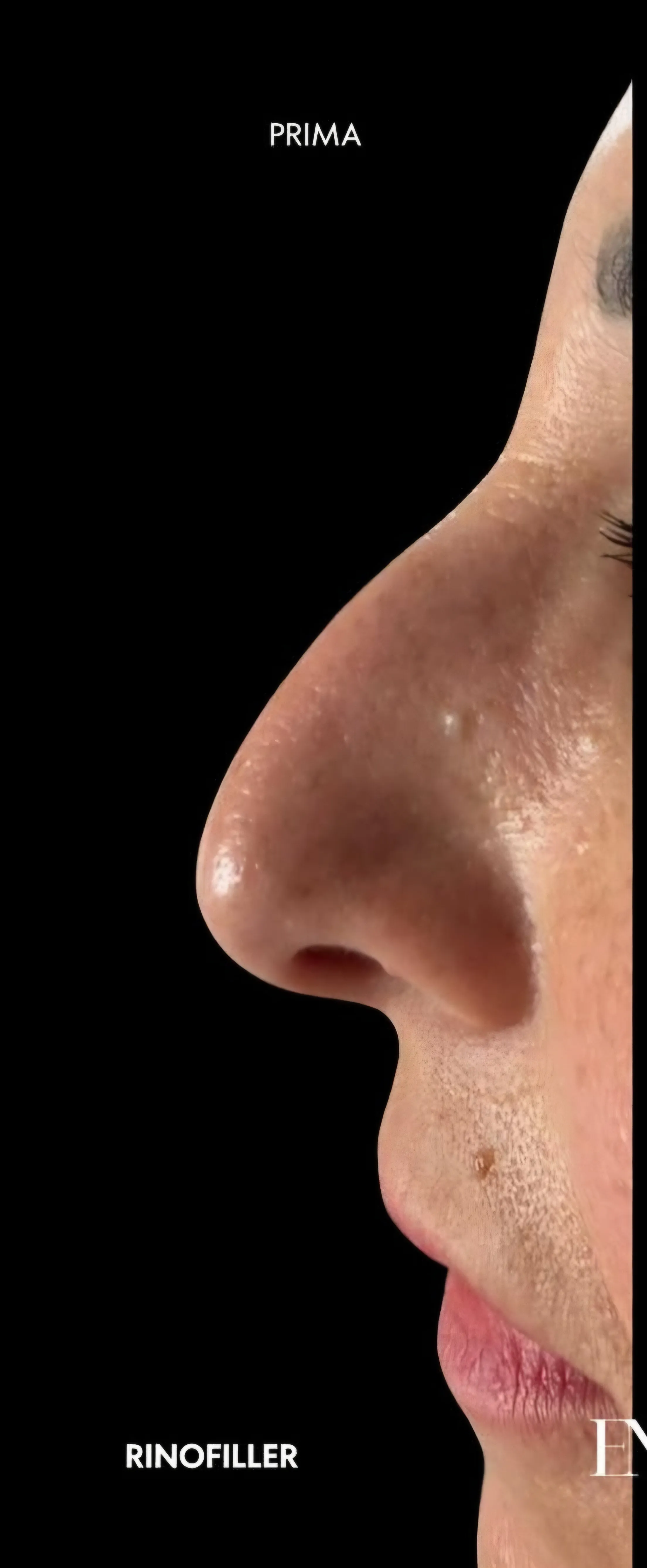 Prima trattamento filler caso 1