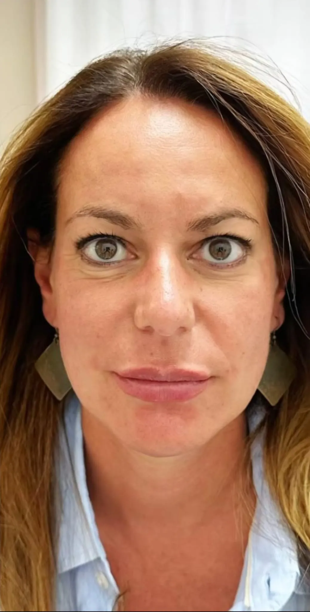 Viso della stessa paziente dopo il trattamento con tossina botulinica, caso 1