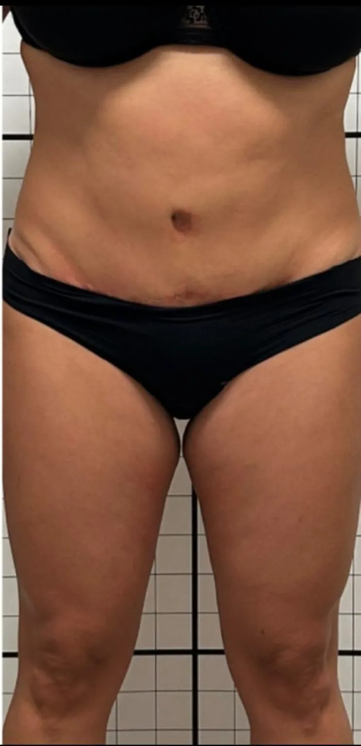 Addome e fianchi dopo il trattamento corpo