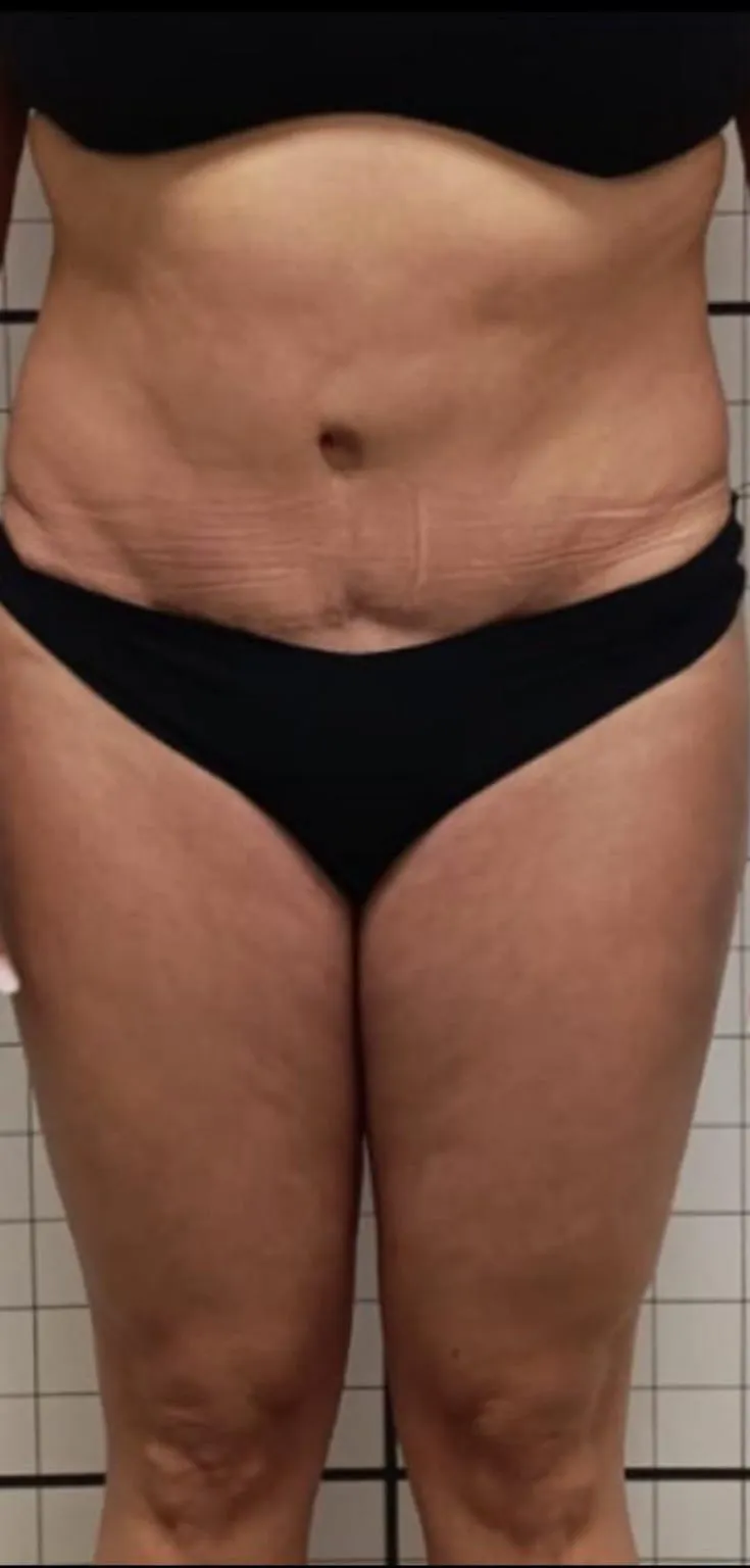 Addome e fianchi prima del trattamento corpo