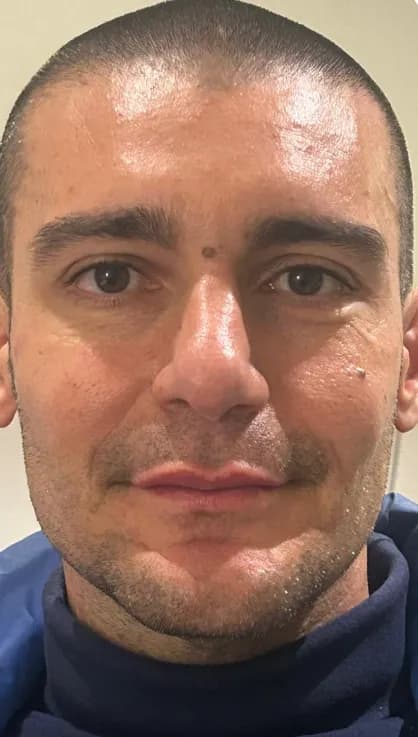 Lo stesso volto dopo il trattamento full face, caso 1