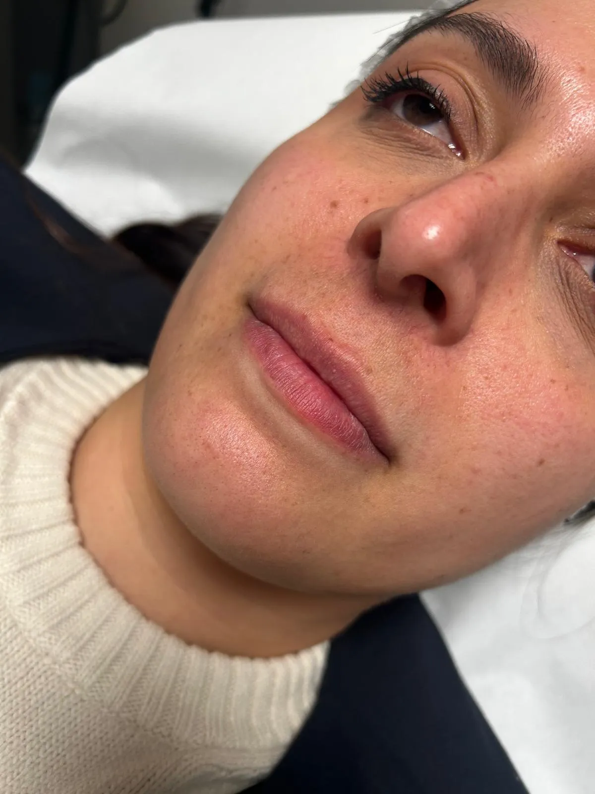 Viso di una paziente prima del trattamento con filler, caso 2