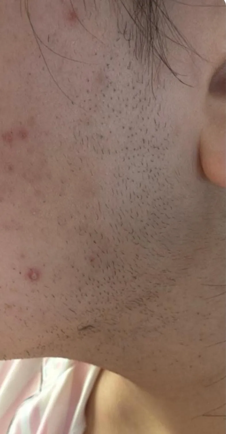 Collo e mandibola con peli prima dell’epilazione laser
