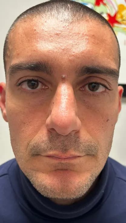 Volto maschile visto di fronte prima del trattamento full face, caso 1
