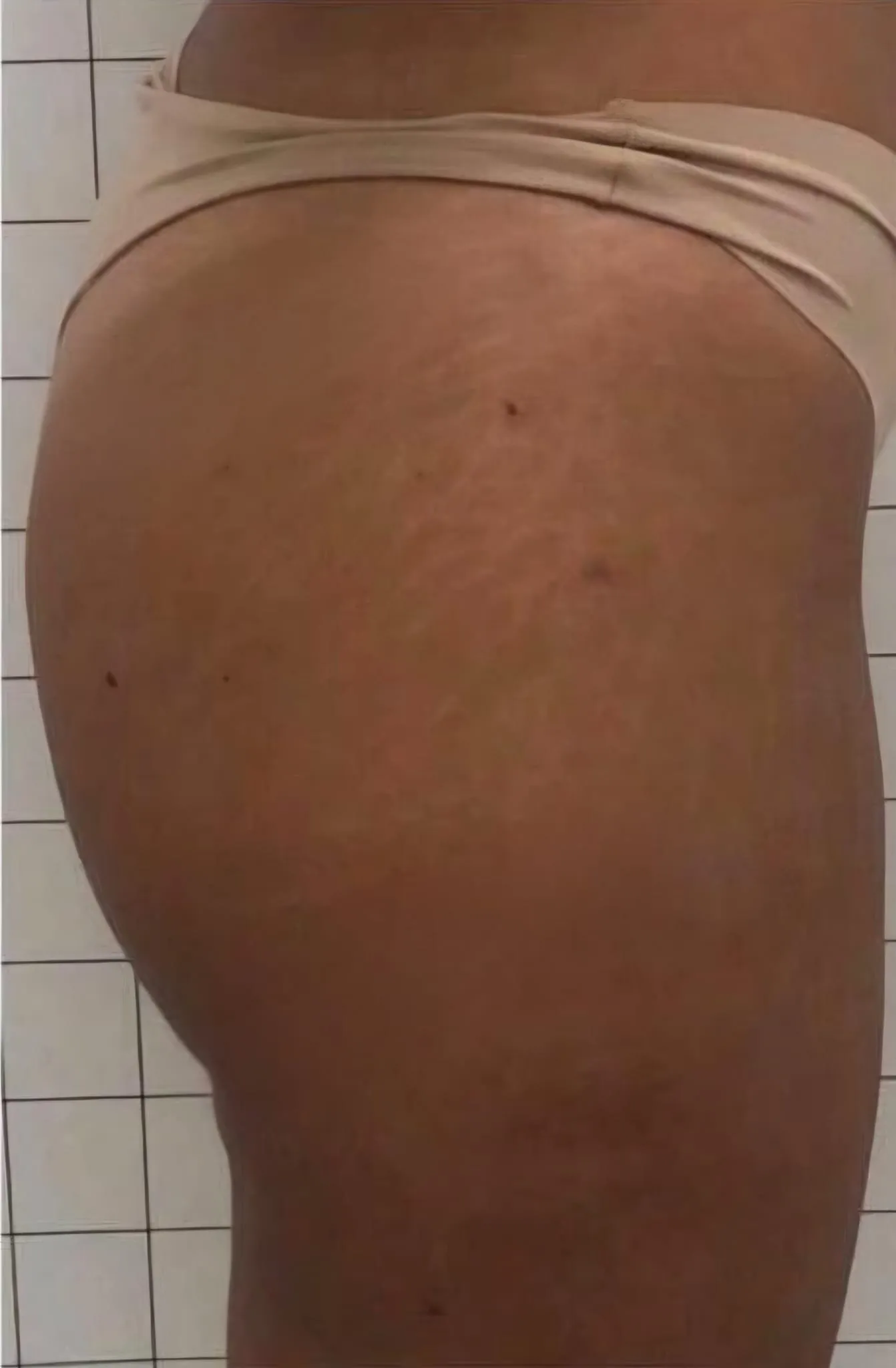 Gluteo e coscia dopo il trattamento delle smagliature, caso 2