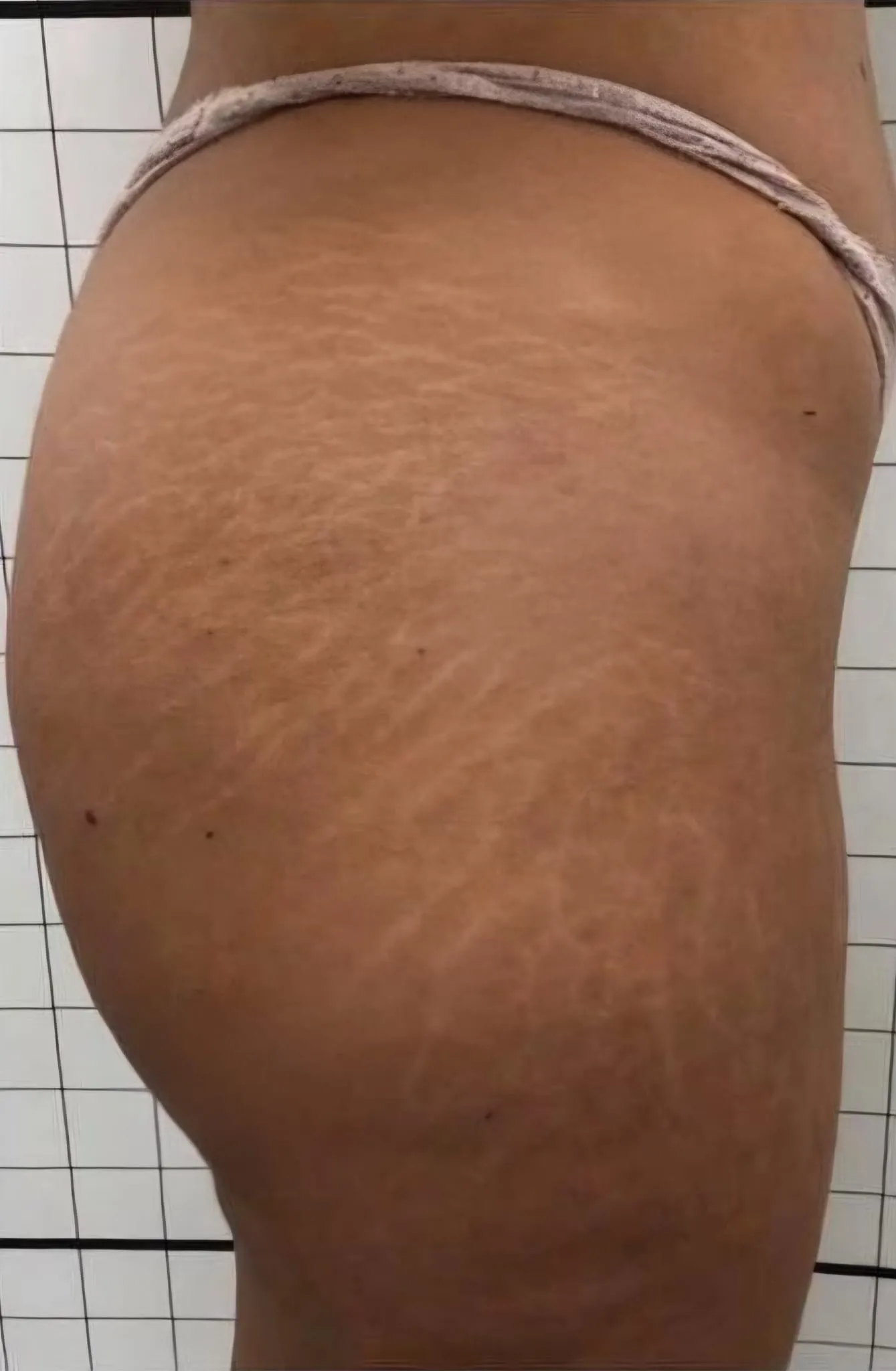 Gluteo e coscia con smagliature prima del trattamento, caso 2